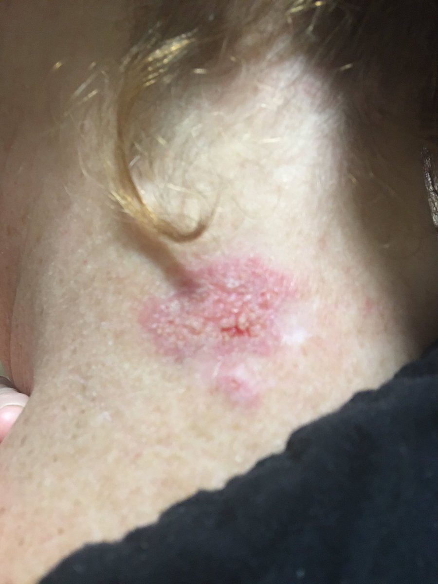 TamRealtor's tweet photo. @CMC_MarineCorps @USMC US Marines help me please as AI is hitting me here in my home Indiana with radiation of some type burning my skin and in my ears pics attached https://t.co/1yX1A367jF