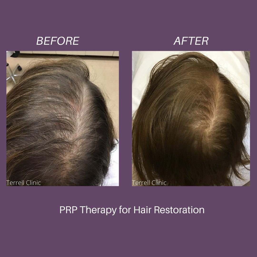 TerrellClinicOK's tweet photo. PRP Therapy is a non-surgical process that stimulates the scalp, skin, and hair follicles and regenerates the growth of healthier, stronger cells using the body’s own healing powers. 
#PRP #PlateletRichPlasma #Medspa #Hairrestoration #SuneticsHairLaser #TerrellClinicOKC #OKC https://t.co/3UyYqJgmKF