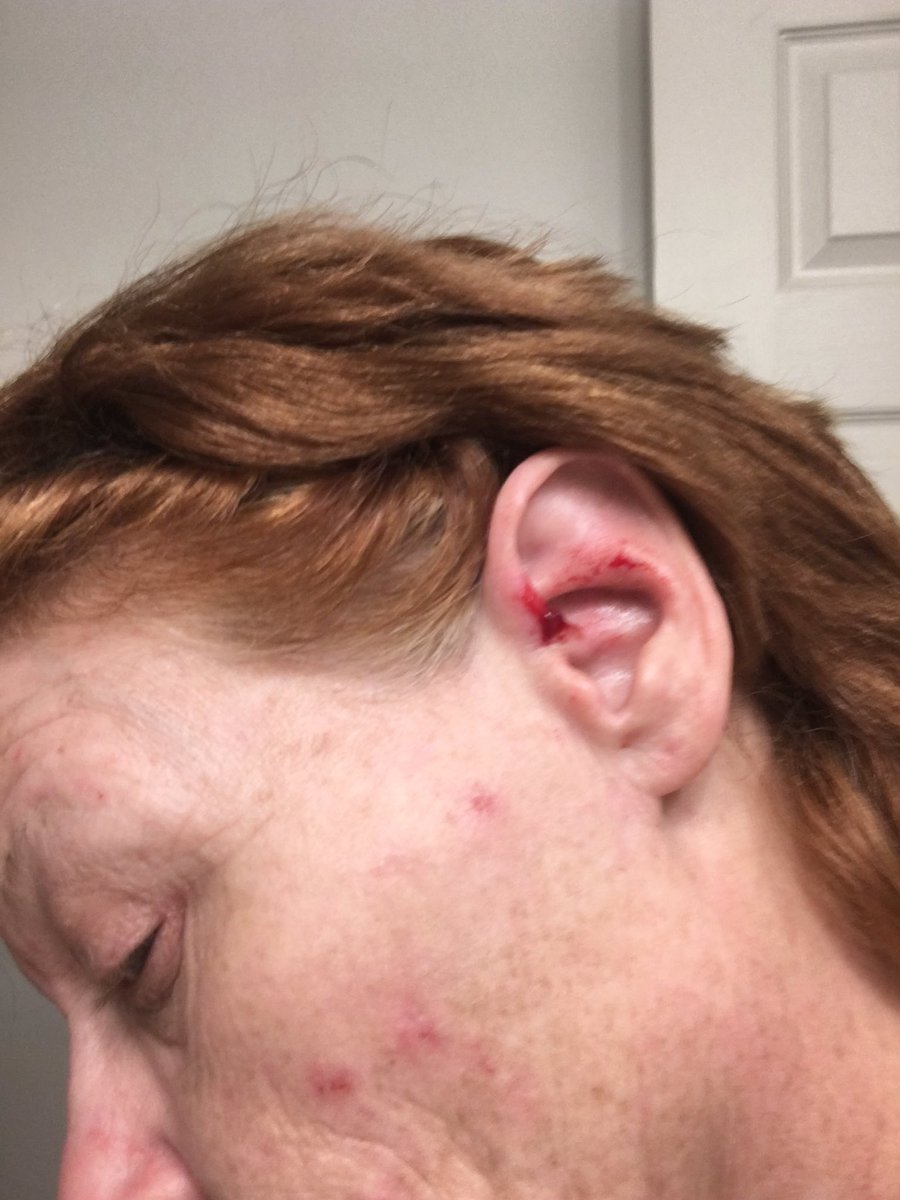 TamRealtor's tweet photo. @us_navyseals US Navy Seals please help me as I am being hit by radiation at my home in Mooresville Indiana possibility AI my skin is peaking off my back. Here are some pics Tammy Bryan https://t.co/k0AzLxm0Nt