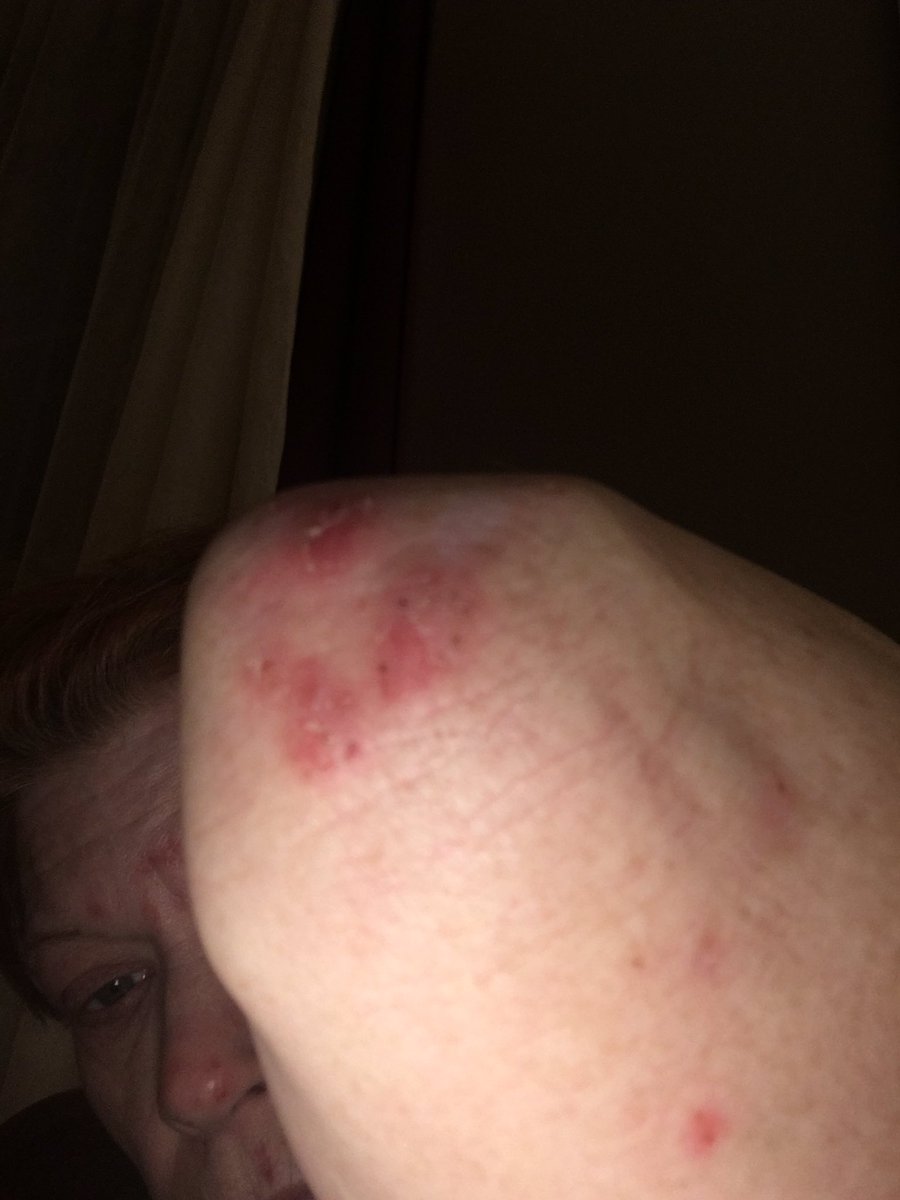 TamRealtor's tweet photo. @us_navyseals US Navy Seals please help me as I am being hit by radiation at my home in Mooresville Indiana possibility AI my skin is peaking off my back. Here are some pics Tammy Bryan https://t.co/k0AzLxm0Nt