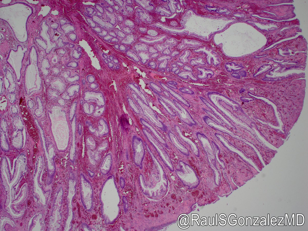 RaulSGonzalezMD's tweet photo. Yesterday's case ... so I never believed in "inflammatory myoglandular polyp," until I saw (and diagnosed) this case. Hope I was right! #pathology #gipath https://t.co/pghNEHPlk8