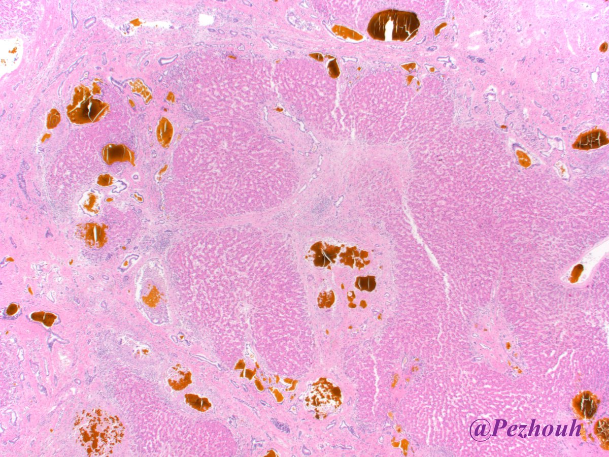 pezhouh's tweet photo. A rare cause of end stage liver disease as a distraction from #COVID19! Notice the markedly dilated ducts with golden-yellow inspissated bile! Caroli disease: only macroscopic cysts no fibrosis. Caroli syndrome: with congenital fibrosis. autosomal recessive disorder. #LiverPath https://t.co/5sL9Q2LXwM
