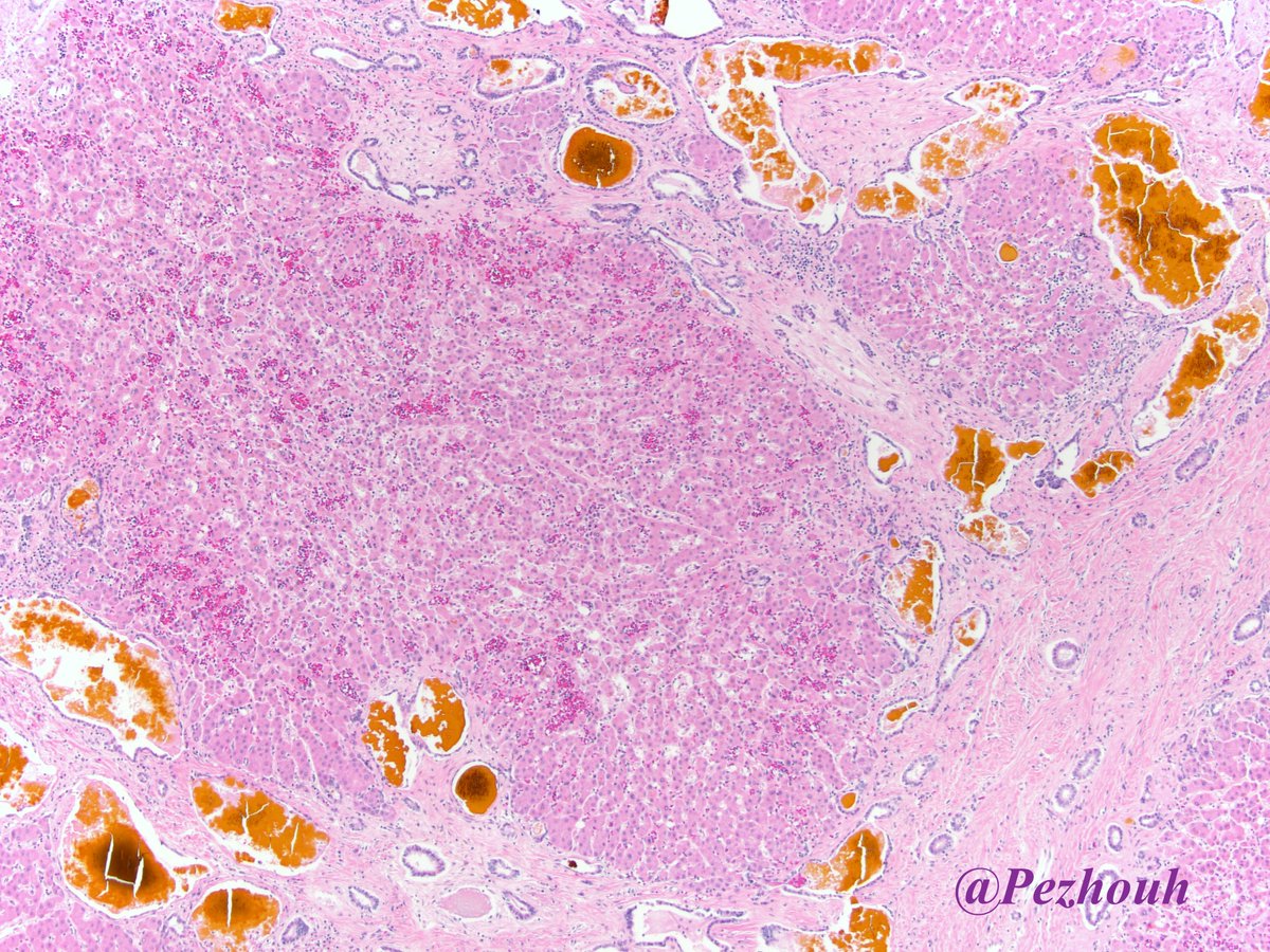 pezhouh's tweet photo. A rare cause of end stage liver disease as a distraction from #COVID19! Notice the markedly dilated ducts with golden-yellow inspissated bile! Caroli disease: only macroscopic cysts no fibrosis. Caroli syndrome: with congenital fibrosis. autosomal recessive disorder. #LiverPath https://t.co/5sL9Q2LXwM