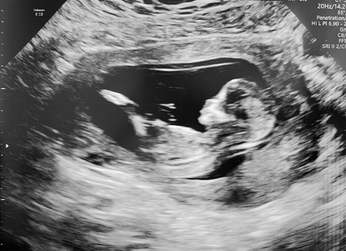 saleenvictoria's tweet photo. feels amazing to finally tell our friends and family that weโre having a baby! ๐ถ๐ฝ๐๐ still cannot believe it! SO BLESSED! #HelloSecondTrimester https://t.co/Bvn6Nl9k0K