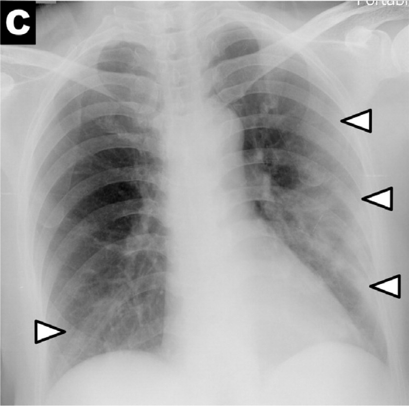 RadiologyEditor's tweet photo. RADIOLOGY New #COVID19:  imaging centers respond to pandemic, more use of chest x-ray - severity peaking days 10-12 after symptom onset.  https://t.co/h25R2xENa7 #radiology @radiology_rsna https://t.co/SjV8Svzr3t