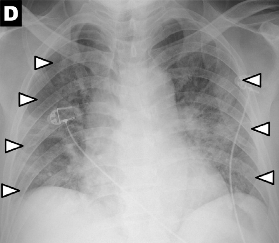 RadiologyEditor's tweet photo. RADIOLOGY New #COVID19:  imaging centers respond to pandemic, more use of chest x-ray - severity peaking days 10-12 after symptom onset.  https://t.co/h25R2xENa7 #radiology @radiology_rsna https://t.co/SjV8Svzr3t