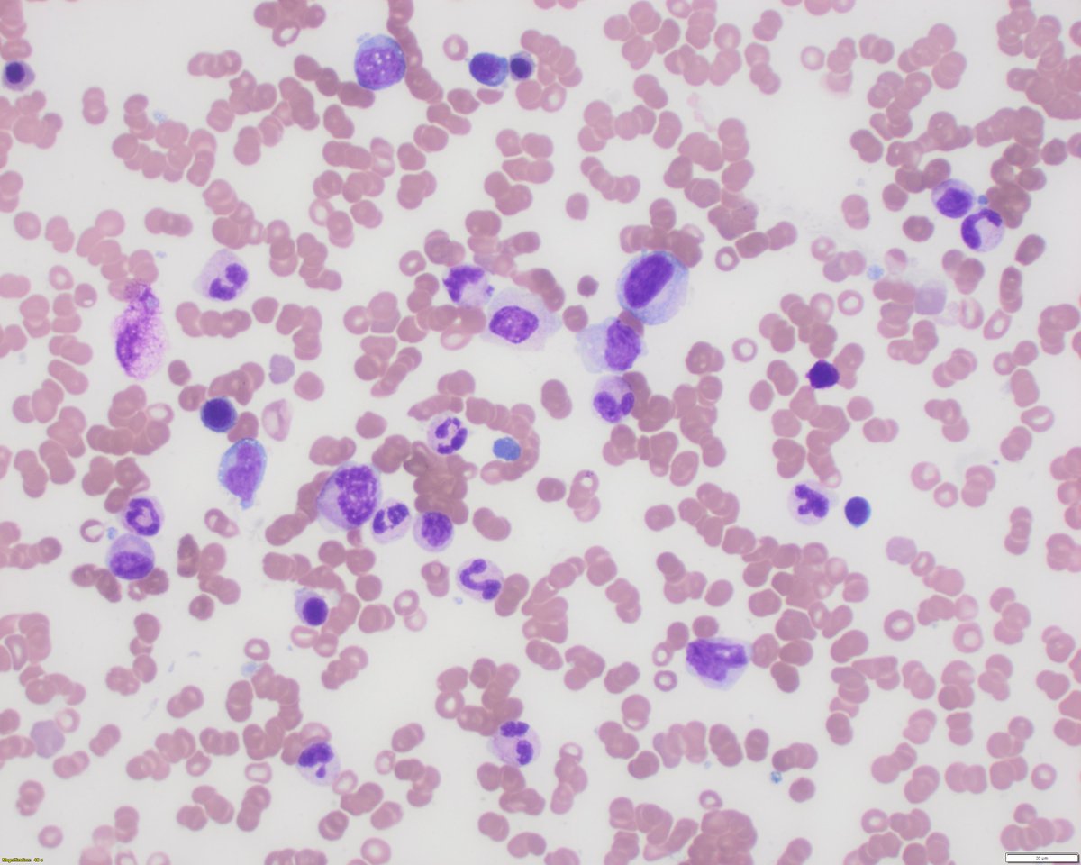 sanamloghavi's tweet photo. #hemapath #hematology lovers: Friday eve & you are asked to release/verify a differential count on this BM aspirate from a pt with anemia and thrombocytopenia. What is your estimated blast percentage? Sorry for 400x pics, hard to get enough cells in 1000x. more pics & poll below: https://t.co/g34NbSOdGD