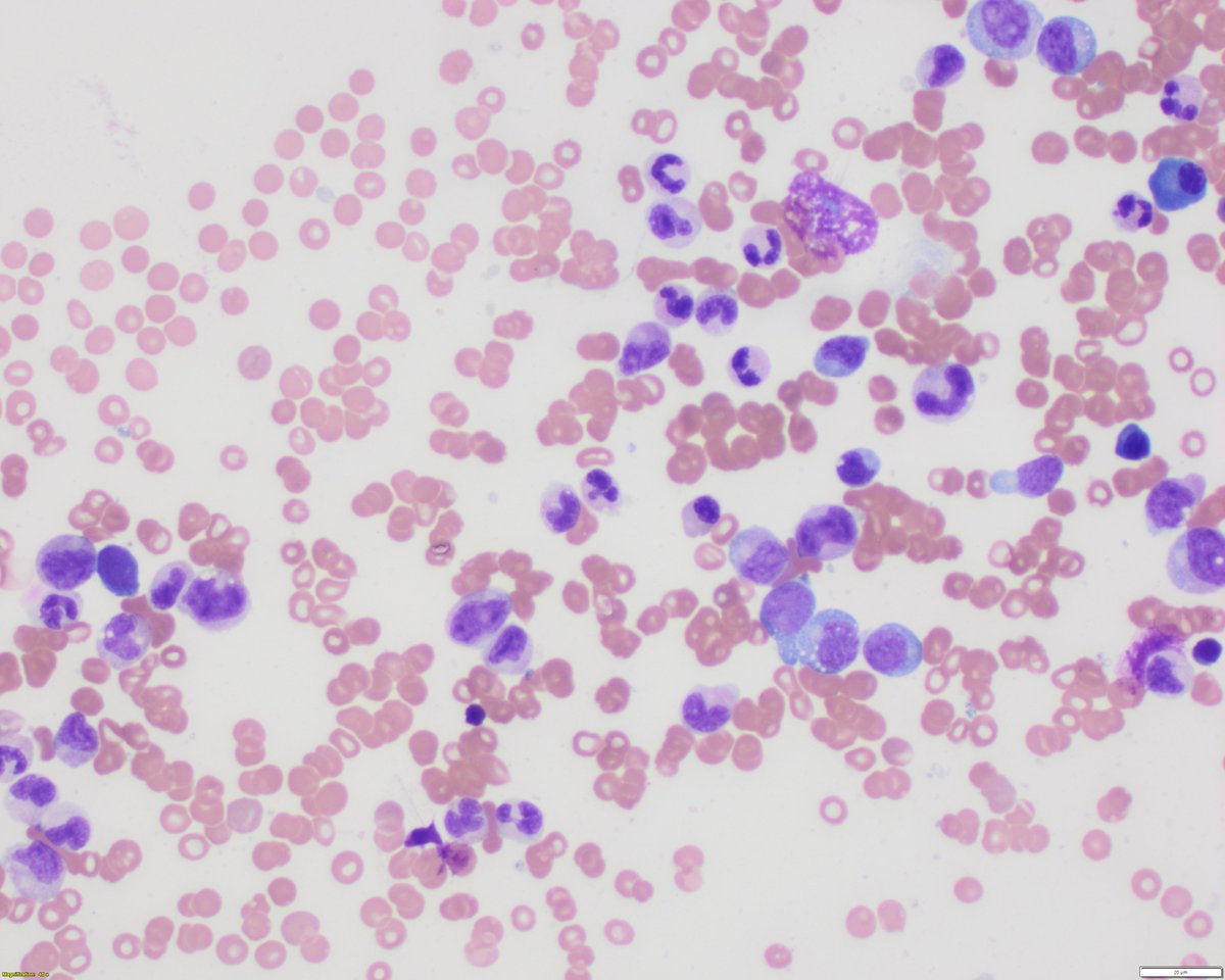 sanamloghavi's tweet photo. #hemapath #hematology lovers: Friday eve & you are asked to release/verify a differential count on this BM aspirate from a pt with anemia and thrombocytopenia. What is your estimated blast percentage? Sorry for 400x pics, hard to get enough cells in 1000x. more pics & poll below: https://t.co/g34NbSOdGD
