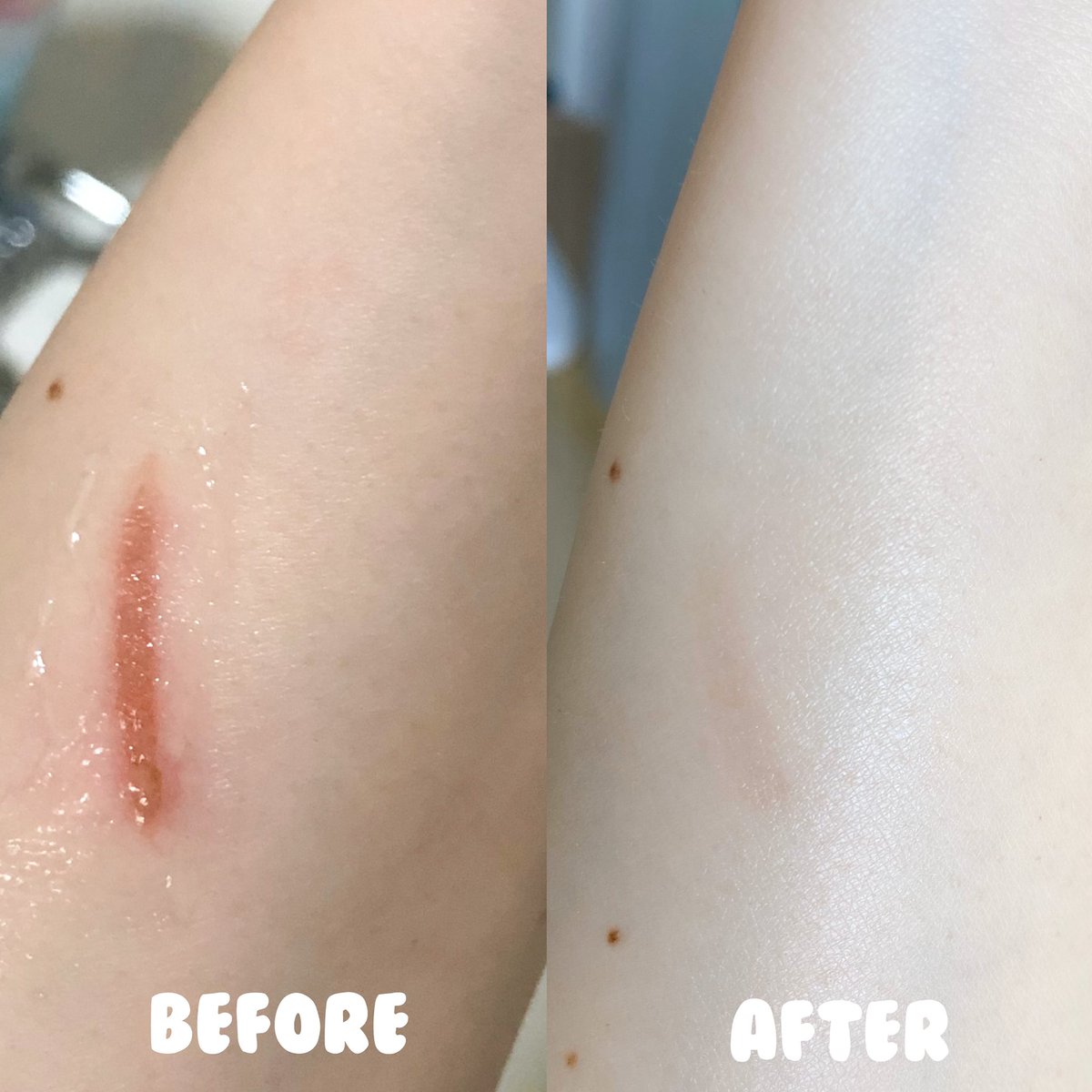 fonfondly's tweet image. ไม่ว่าจะมีแผลแบบไหนเราก็ต้องรอดค่าาา !
ความเป็นผู้หญิงซุ่มซ่ามไม่ระมัดระวังตัวของเราทำให้เกิดอุบัติเหตุบ่อย แล้วแผลที่เกิดขึ้นมีโอกาสที่จะเป็นแผลเป็น
ดังนั้นเวลาที่ฝนมีแผล แผลเริ่มแห้งปุ๊บ ฝนจะทา Mederma Intense Gel ทันที