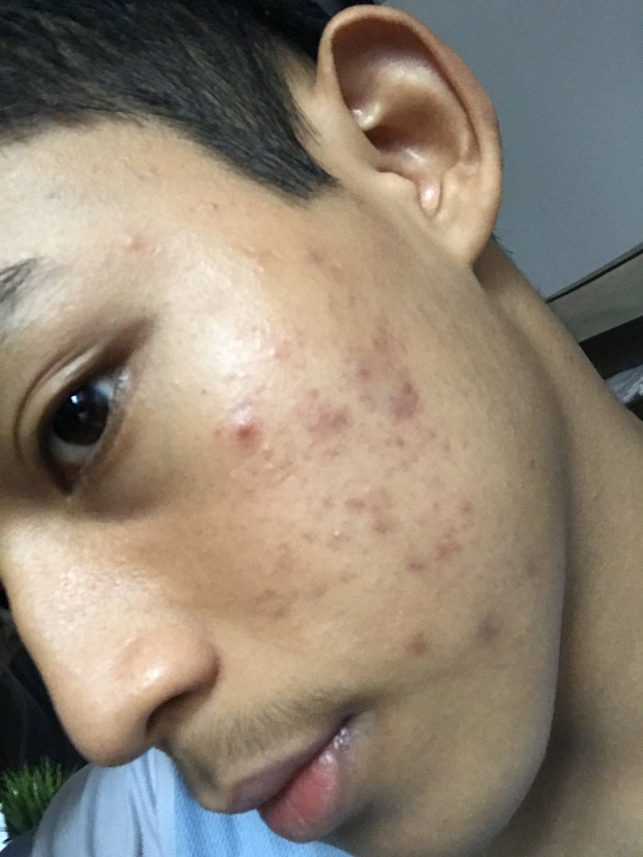 Syameel On Twitter Skincare Thread By Sy4meel