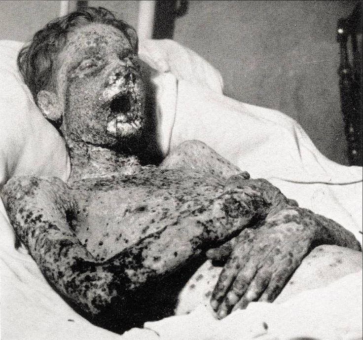 Smalpox disease was the greatest killer of history.Many world famous kings & queens, famous people died of smallpox. In 1010 AD Gujarat 3rd Solanki king Vallabhraj died due to smallpox after rule of 6 months.Mahmud Ghazni,Akbar,Abraham Lincoln & Stalin were survivors of smallpox.