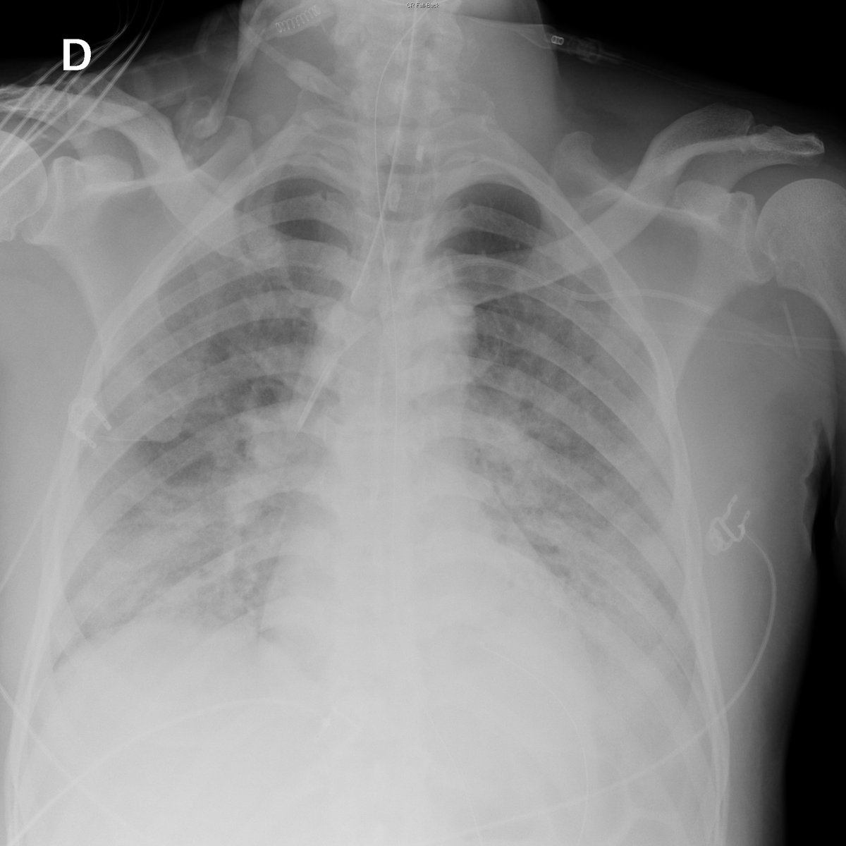 Case 2. 47yo male. Fever. Day 1, 4, 8 and 12 after ER arrival.