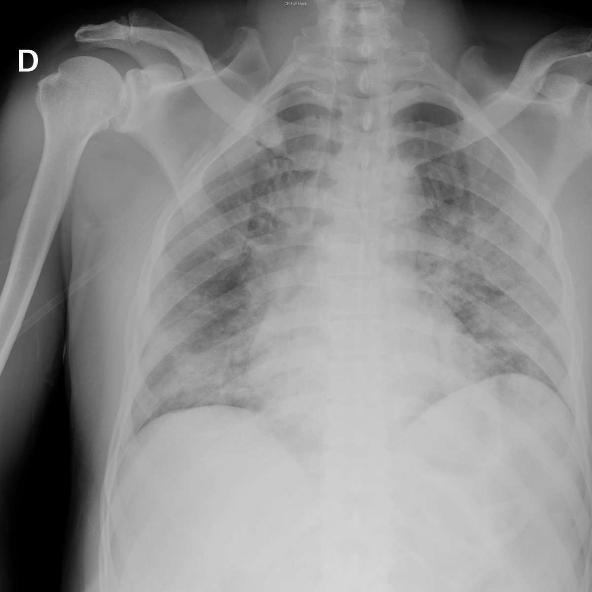 Case 2. 47yo male. Fever. Day 1, 4, 8 and 12 after ER arrival.