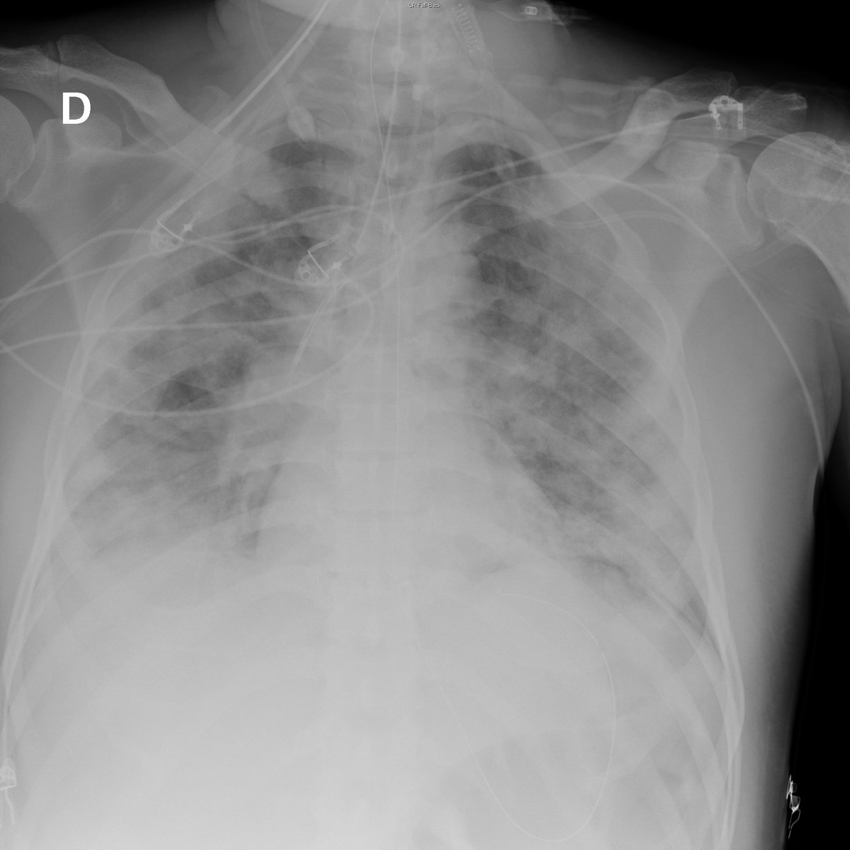 Case 2. 47yo male. Fever. Day 1, 4, 8 and 12 after ER arrival.