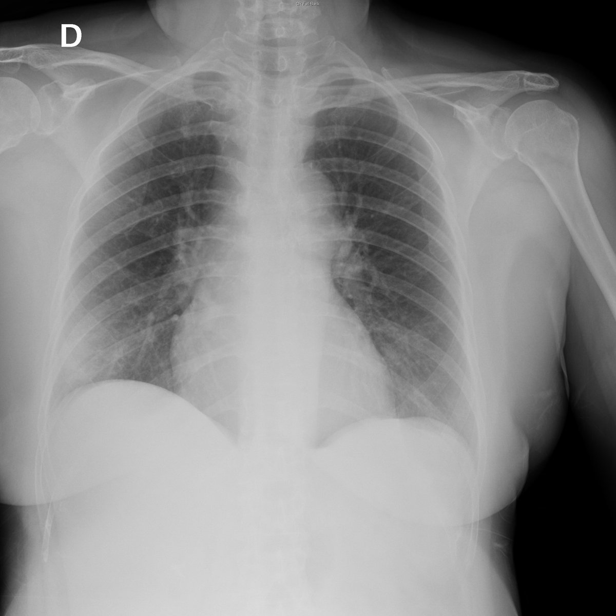 This is a thread of COVID-19 CXR (all SARS-CoV-2 PCR+) from my hospital (Spain). I hope it could help.Case 1. 68yo female. Cough and fever.