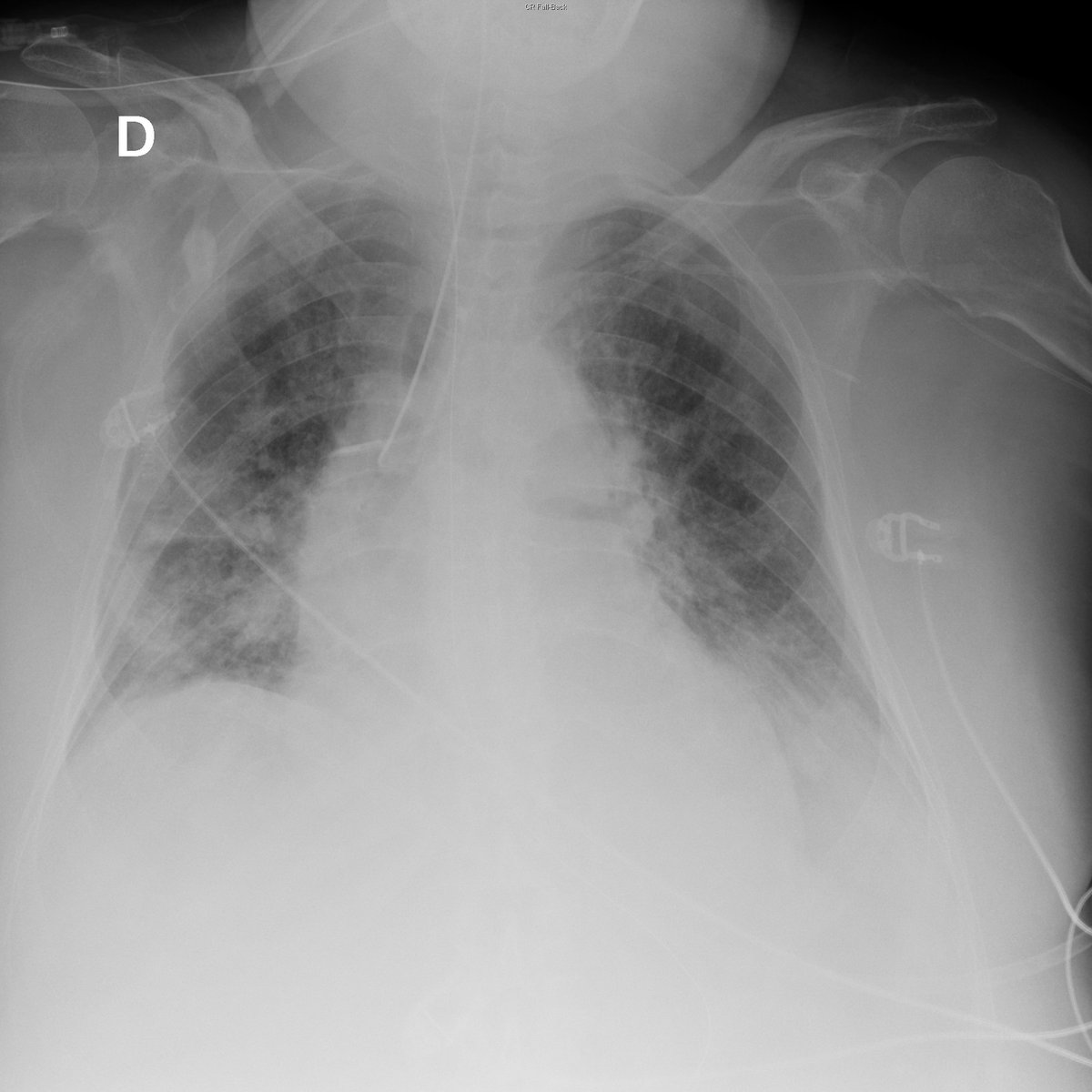 Case 4. 86yo male. Fever. Day 1, 3, 4 and 8 after ER arrival.