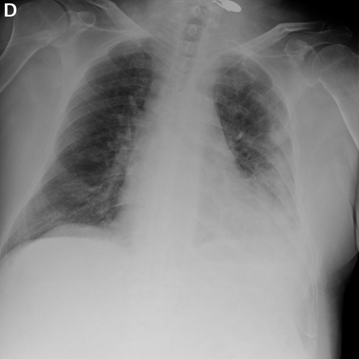 Case 4. 86yo male. Fever. Day 1, 3, 4 and 8 after ER arrival.