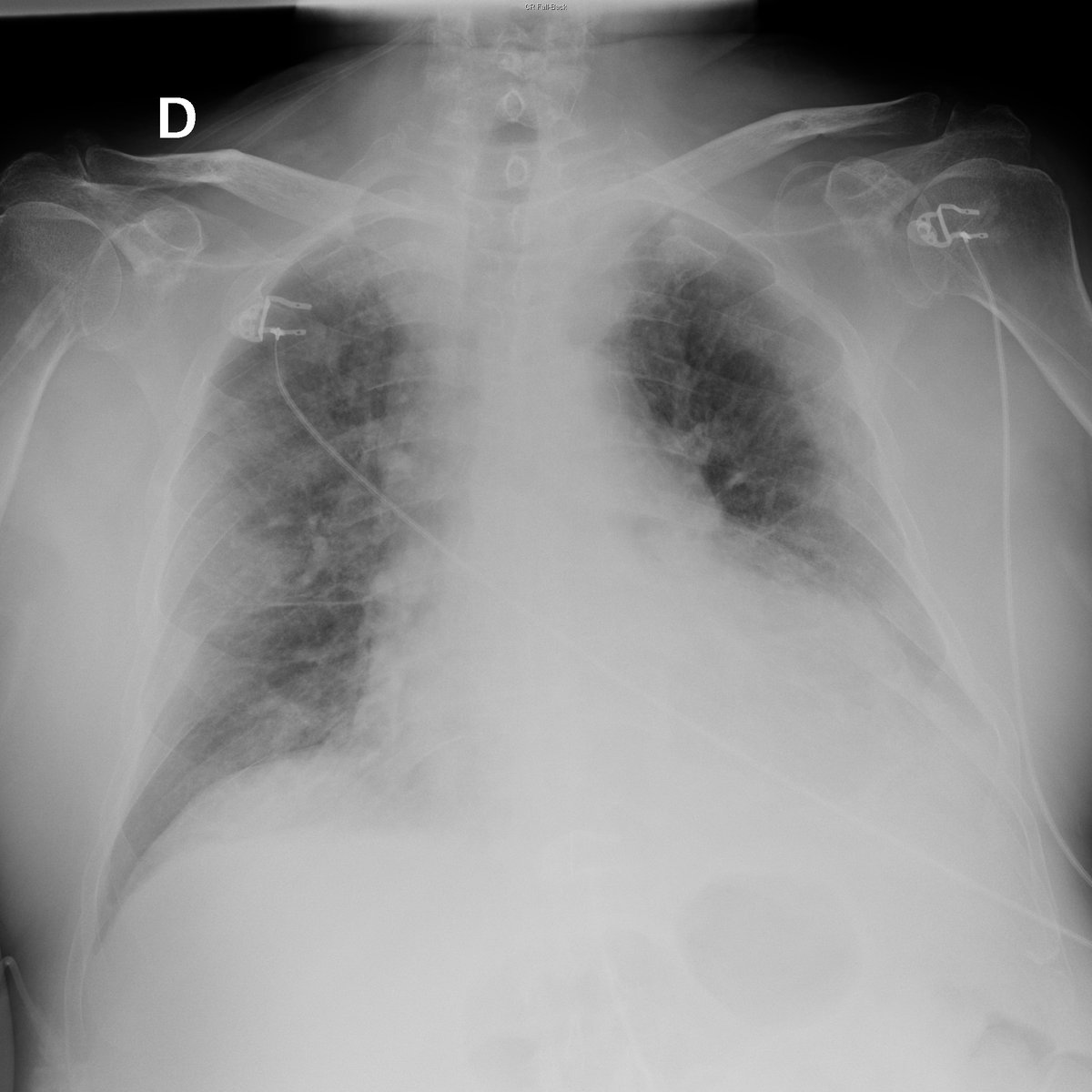 Case 4. 86yo male. Fever. Day 1, 3, 4 and 8 after ER arrival.