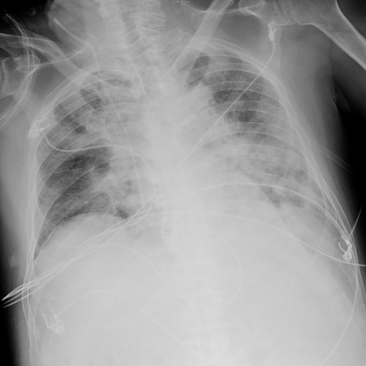 Case 7. 70yo male. Fever. Day 1, 3, 5 and 7.