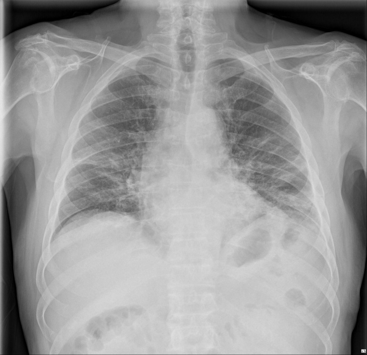 Case 6. 80yo male. Chest pain.