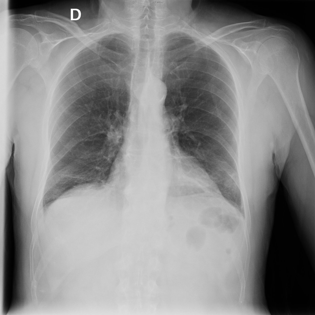 Case 9. 67yo male. Cough and low grade fever. Day 1 (PA-L) and 7.