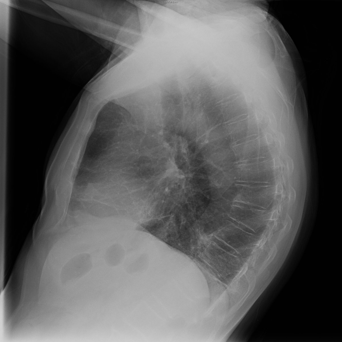 Case 9. 67yo male. Cough and low grade fever. Day 1 (PA-L) and 7.