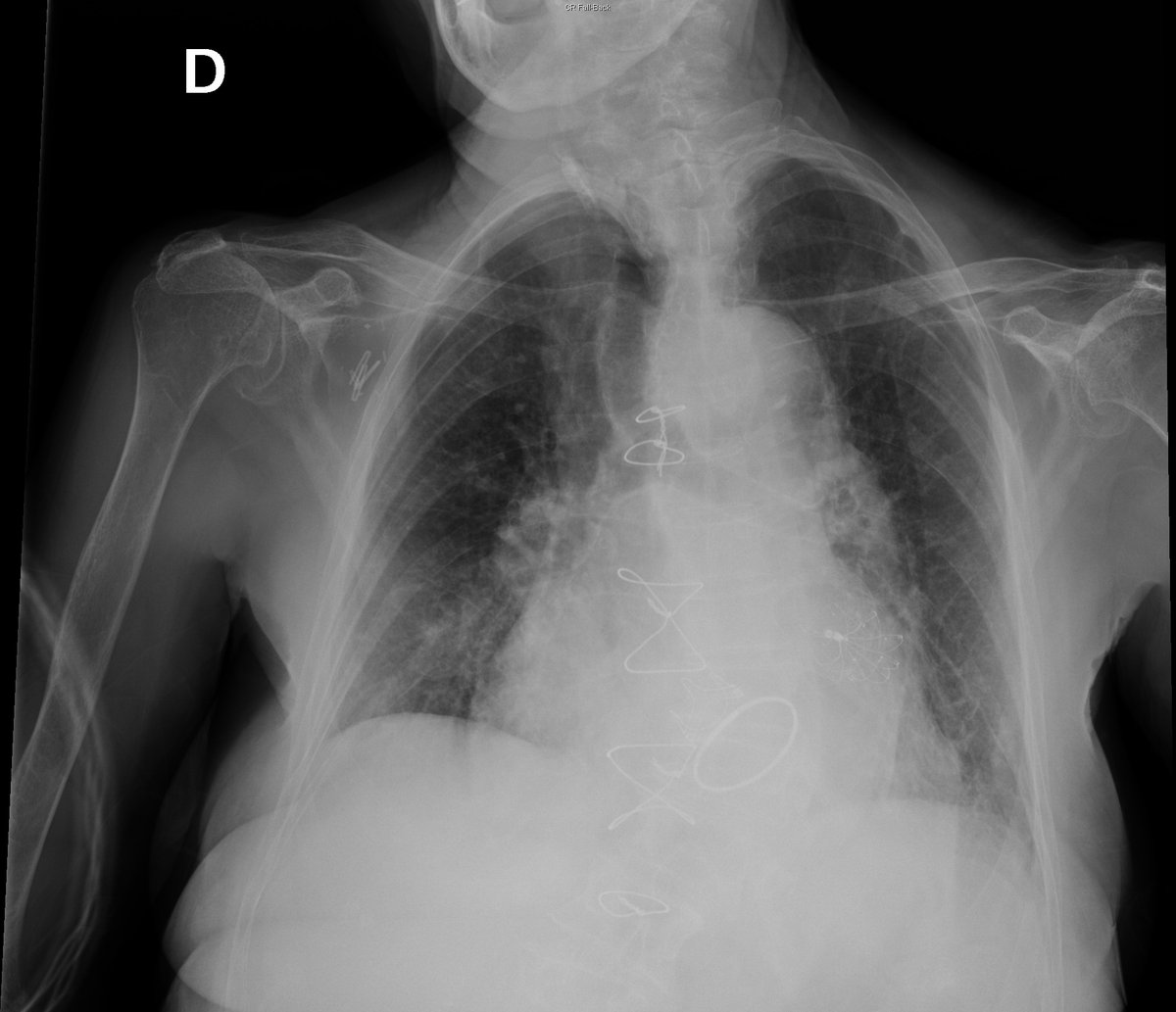 Case 11. 79yo female. Cough and fever. Day 1, 4 and 8.