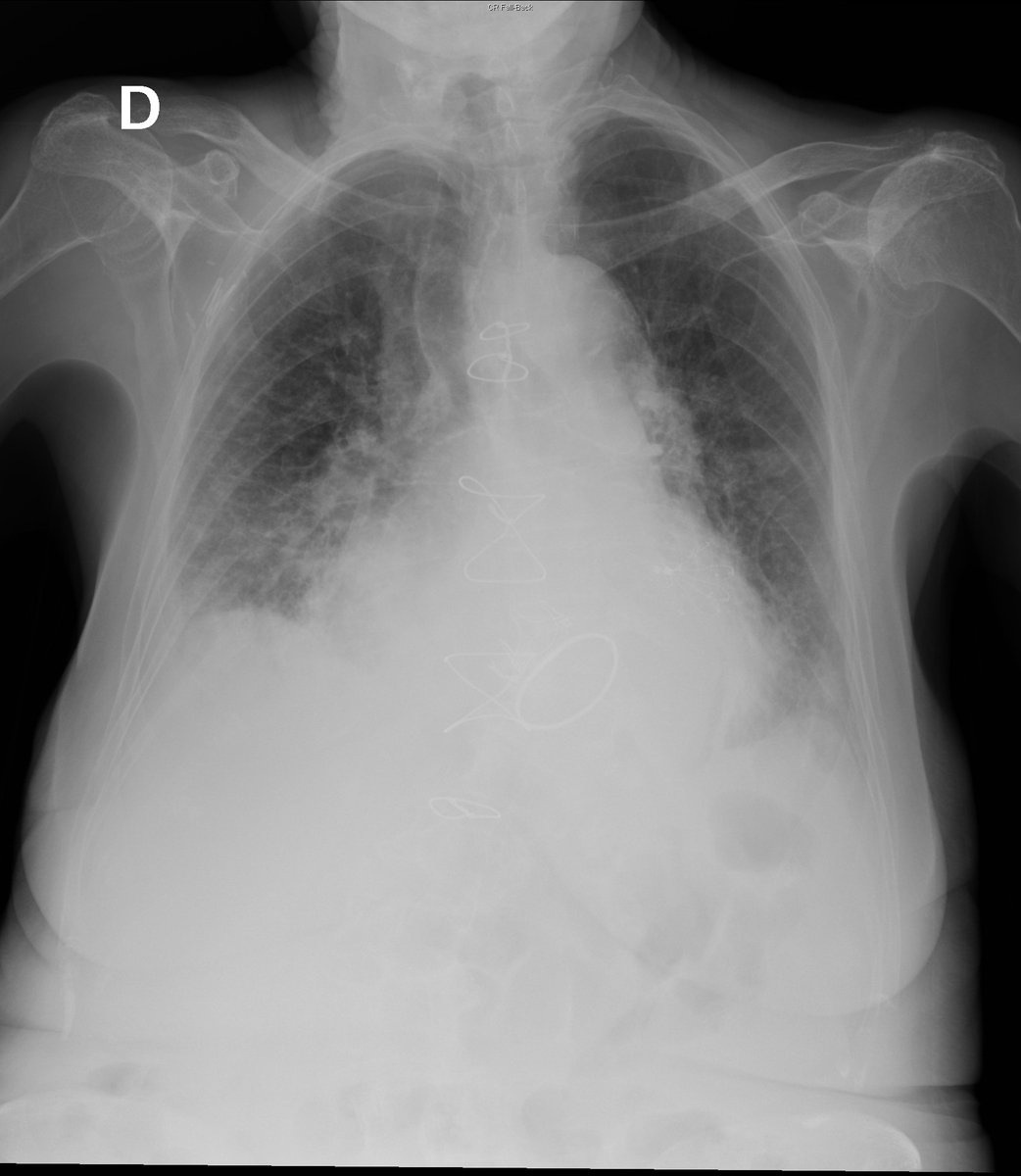 Case 11. 79yo female. Cough and fever. Day 1, 4 and 8.