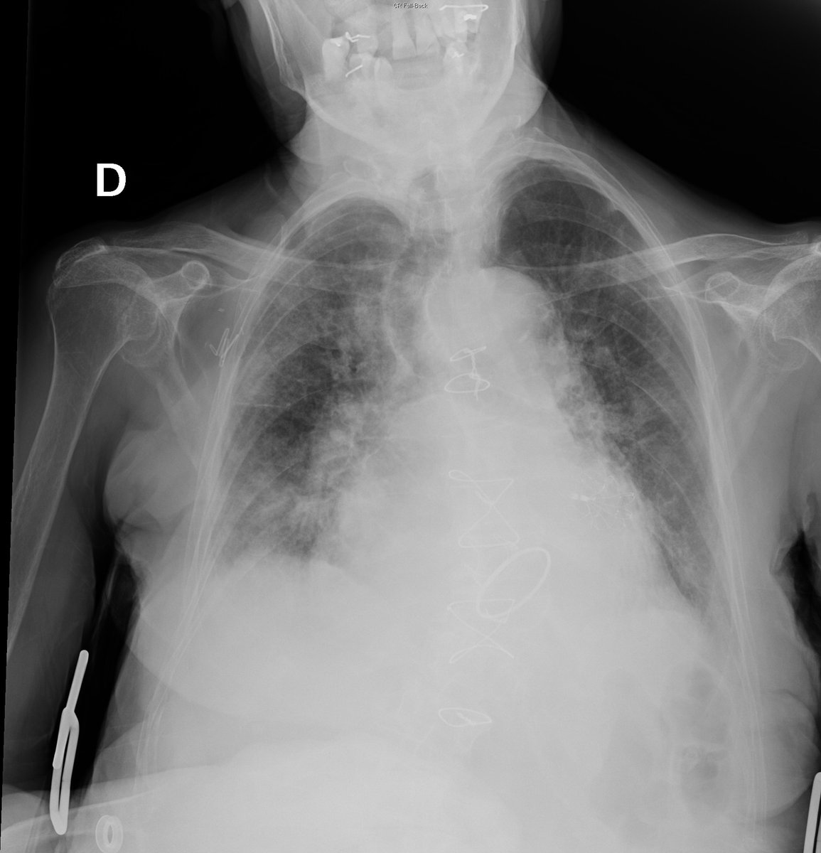 Case 11. 79yo female. Cough and fever. Day 1, 4 and 8.