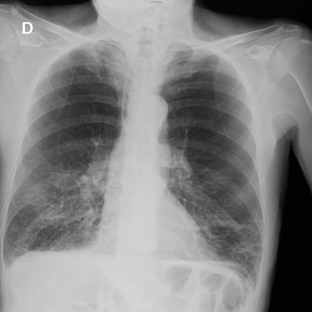 Case 10. 76yo male. SOB. Severe emphysema. Day 1, 3, 5 and 8.