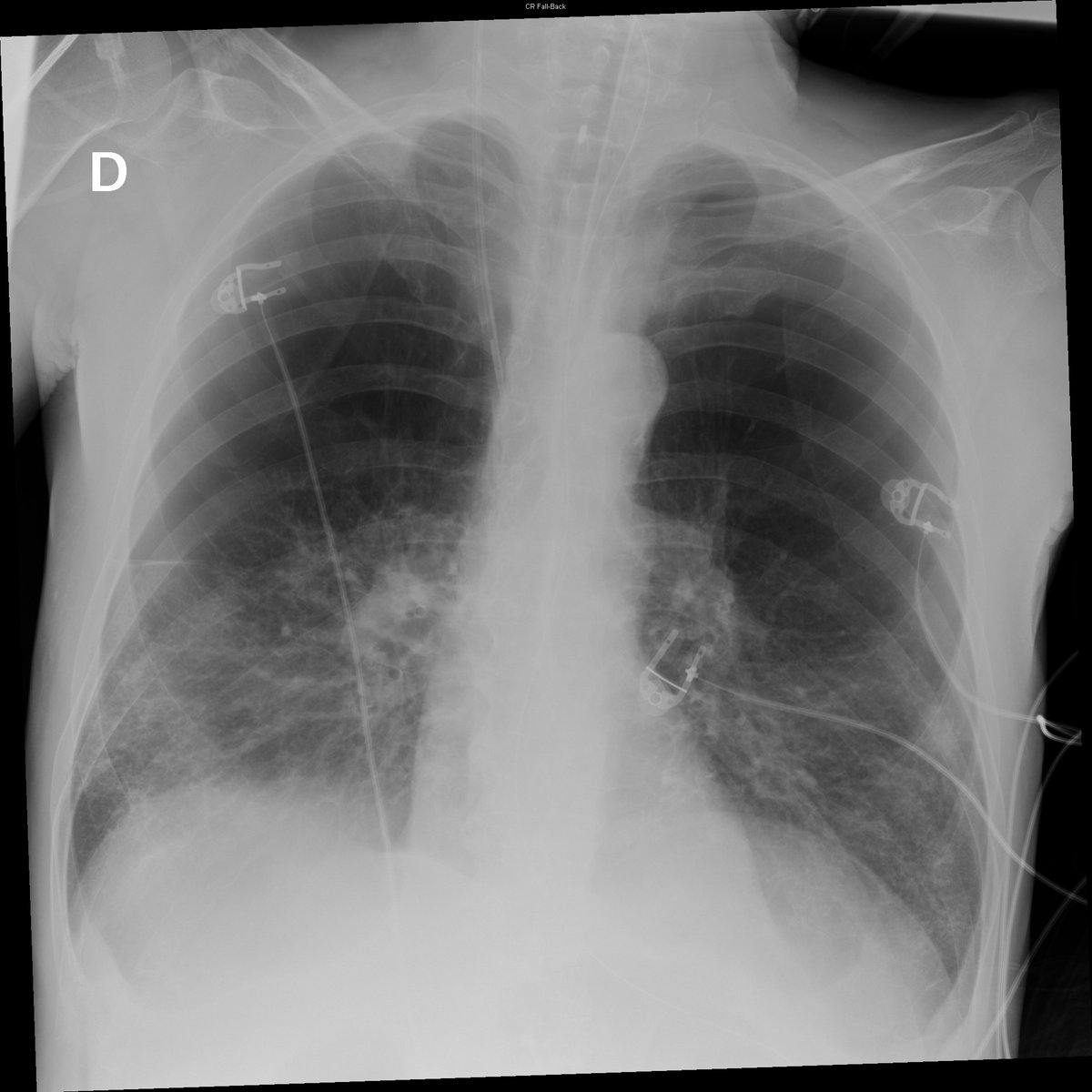 Case 10. 76yo male. SOB. Severe emphysema. Day 1, 3, 5 and 8.