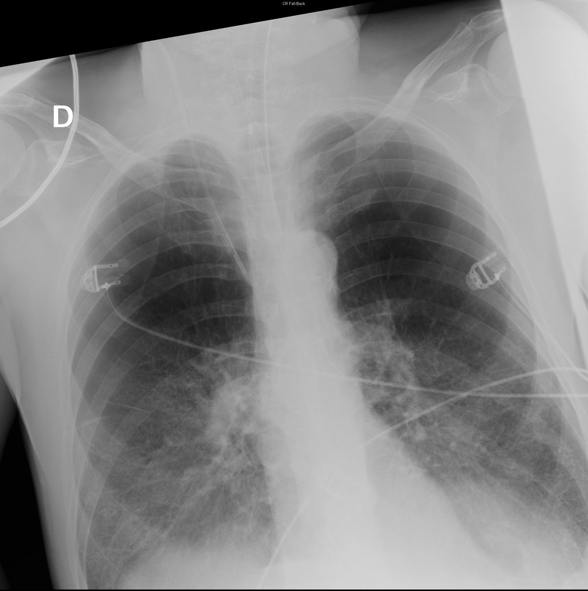 Case 10. 76yo male. SOB. Severe emphysema. Day 1, 3, 5 and 8.