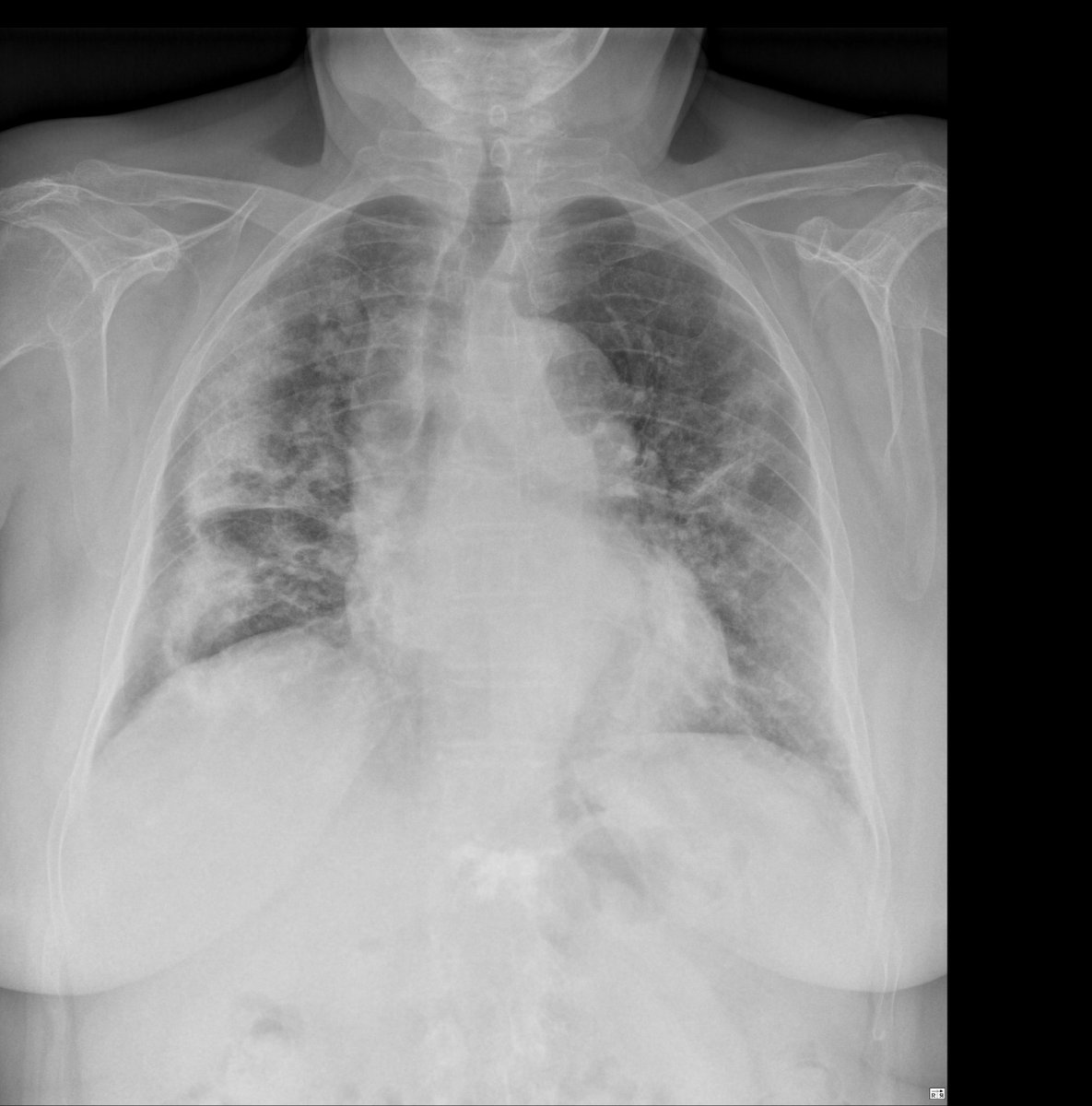 Case 13. 77yo female. Abdominal pain. Day 1, 2, 7 and 8.