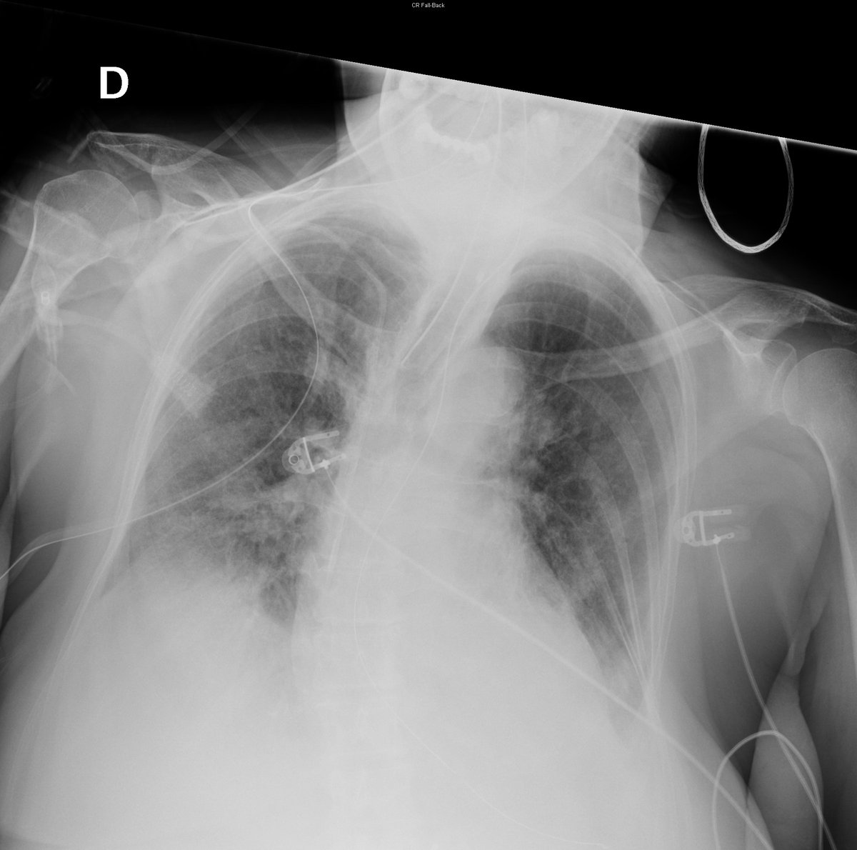 Case 13. 77yo female. Abdominal pain. Day 1, 2, 7 and 8.