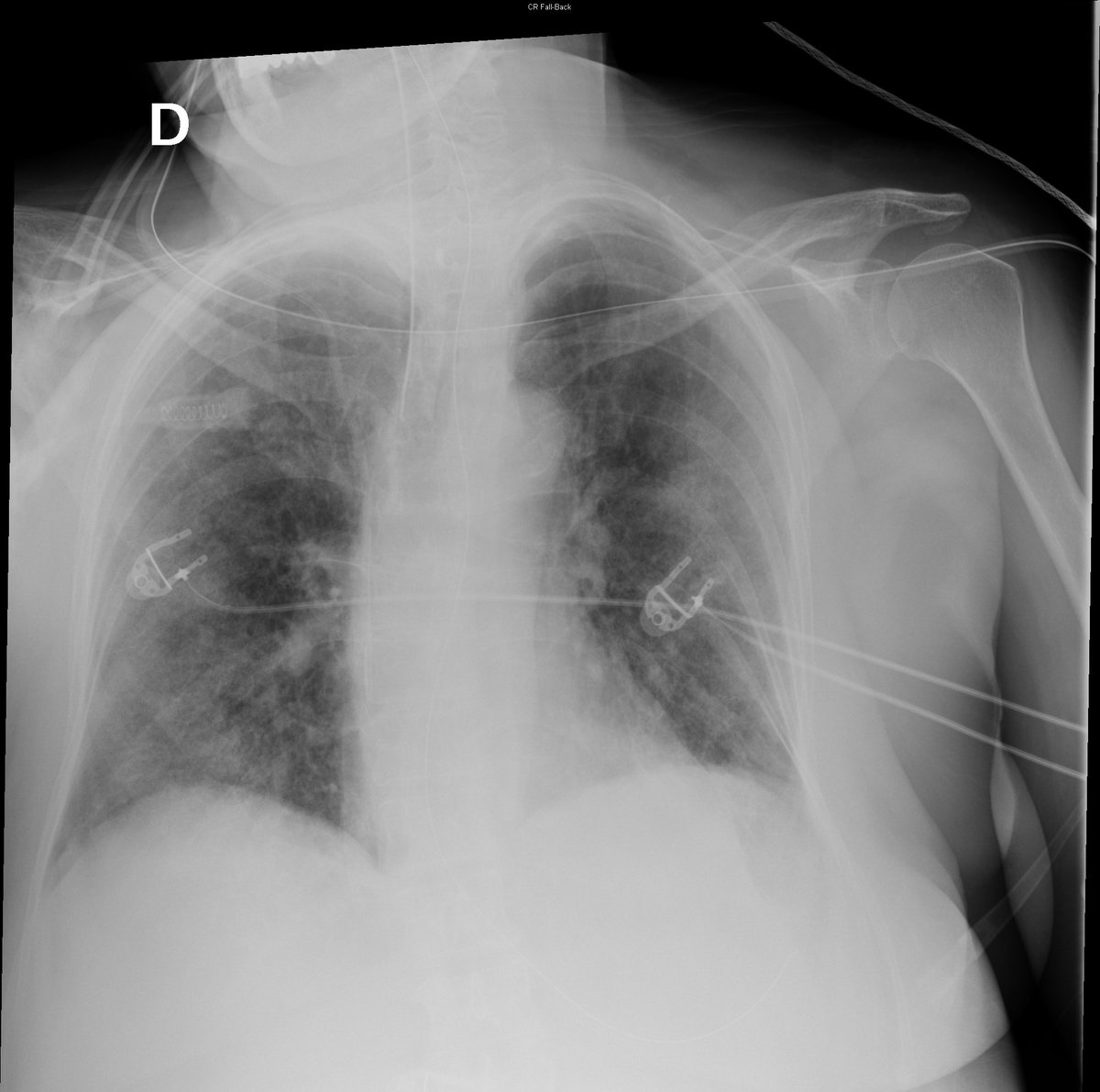 Case 13. 77yo female. Abdominal pain. Day 1, 2, 7 and 8.