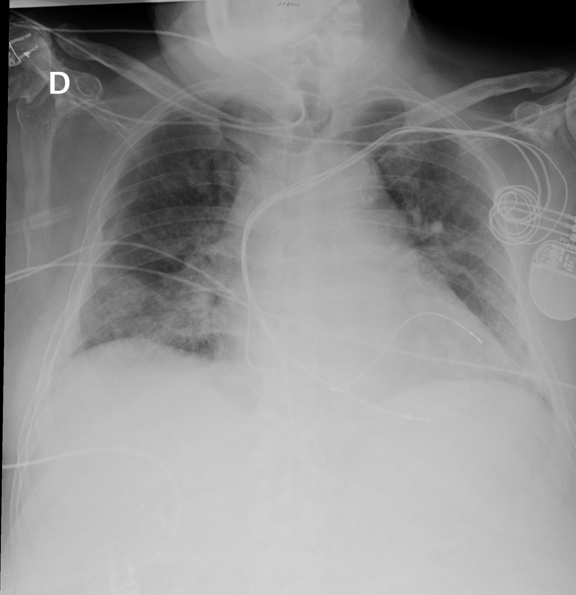 Case 12. 73yo male. Dyspnea and fever. Day 1 and 3.