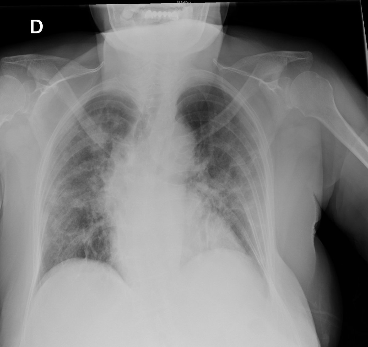 Case 14. 77yo female.