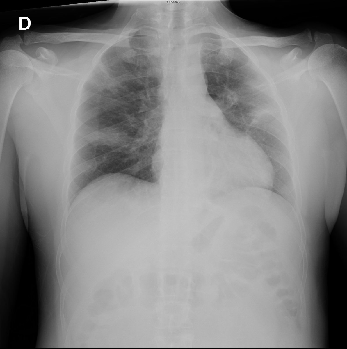 Case 15. 44yo male. Fever. Day 1, 4 (add cough and dyspnea), 6, 7 (...)