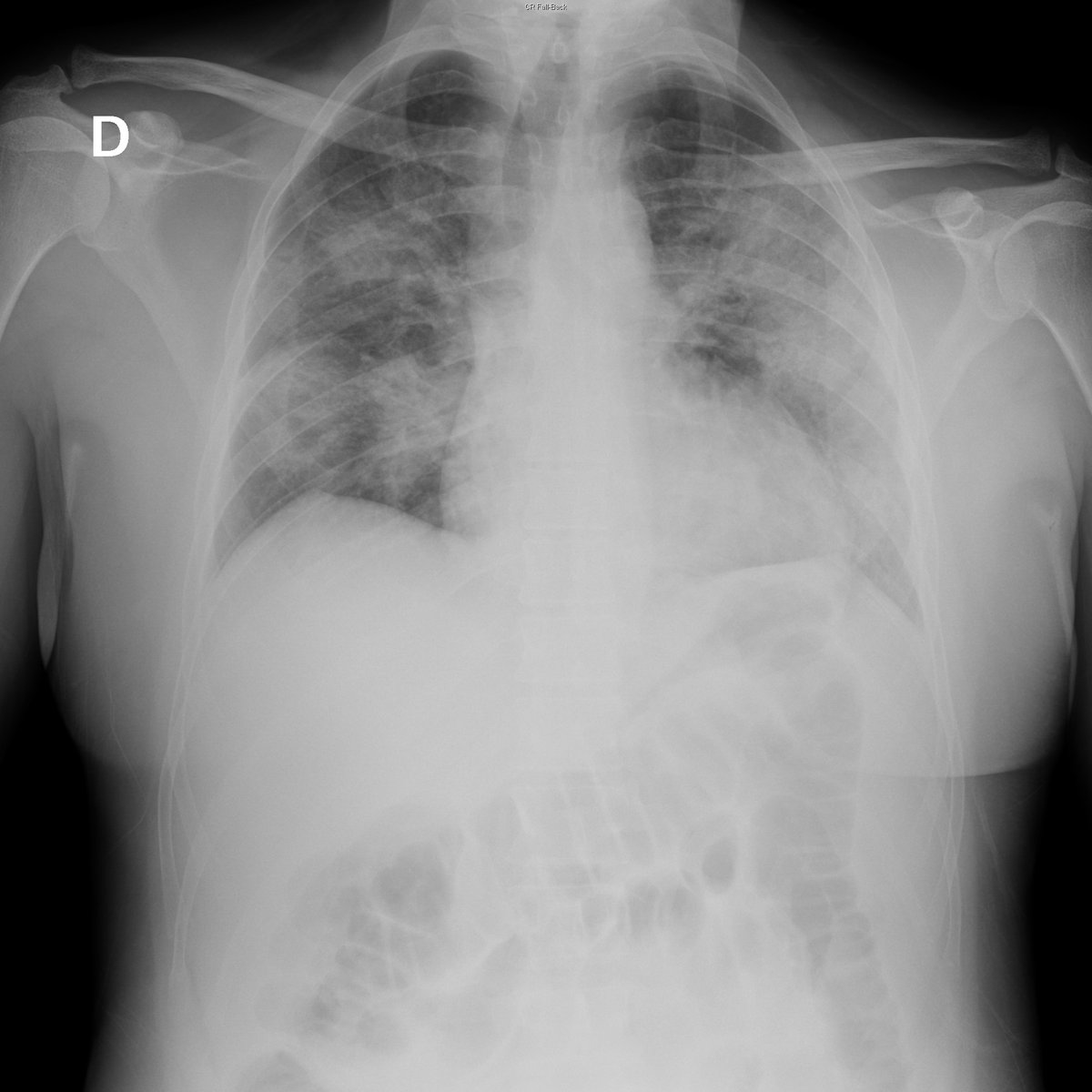 Case 15. 44yo male. Fever. Day 1, 4 (add cough and dyspnea), 6, 7 (...)