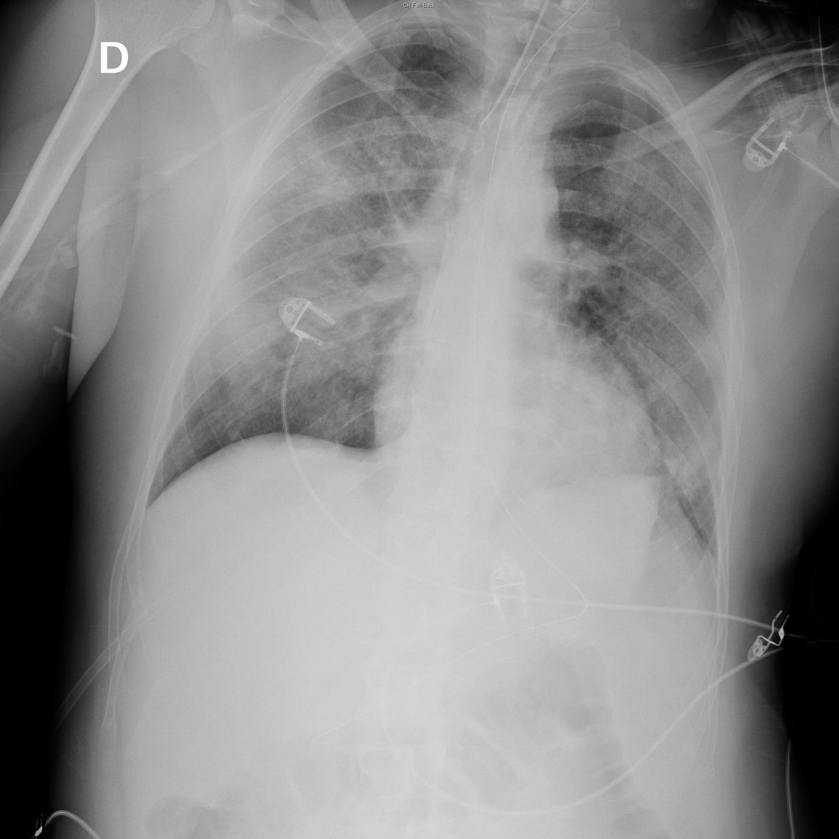 Case 15. 44yo male. Fever. Day 1, 4 (add cough and dyspnea), 6, 7 (...)
