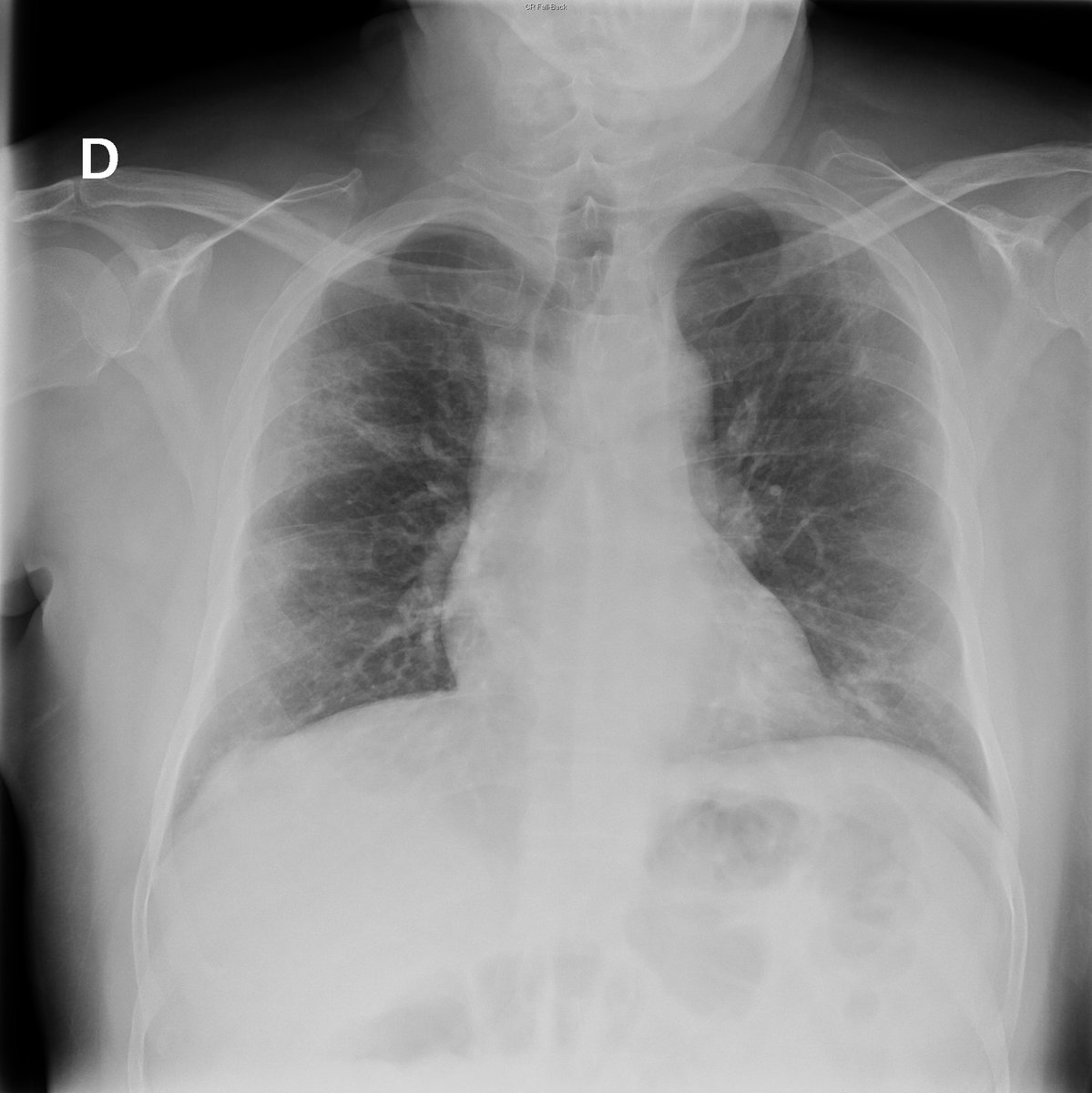 Case 18. 64yo male. Fever and dyspnea.