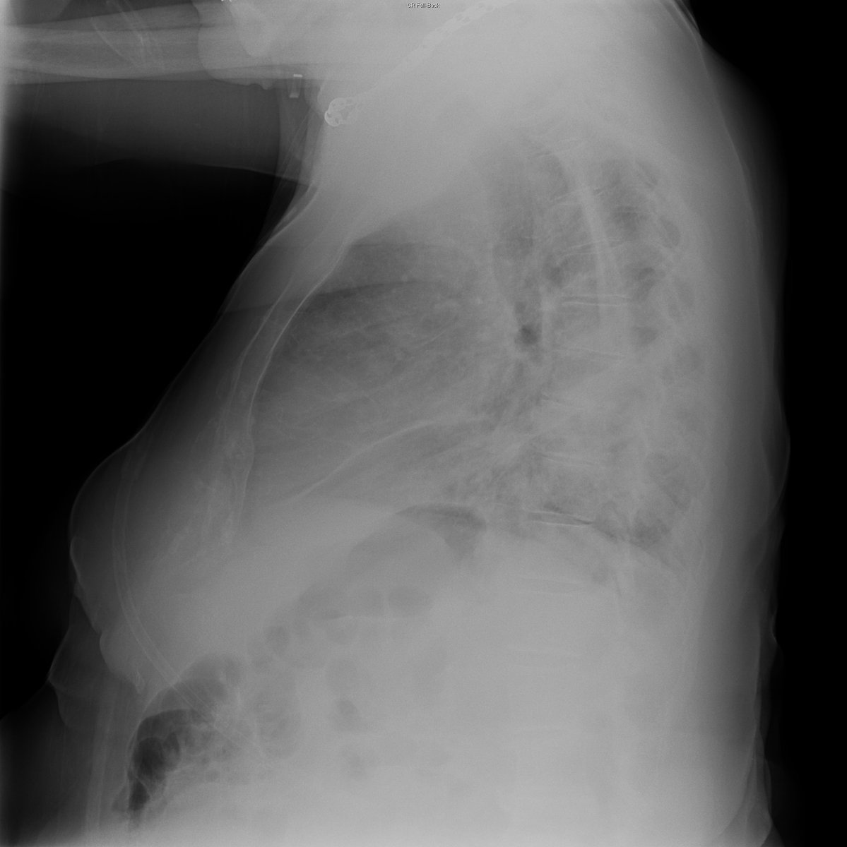 Case 16. 77yo male. Dyspnea. Day 1 (PA-L) and 3.