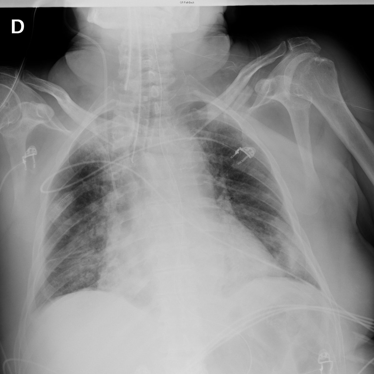 Case 16. 77yo male. Dyspnea. Day 1 (PA-L) and 3.