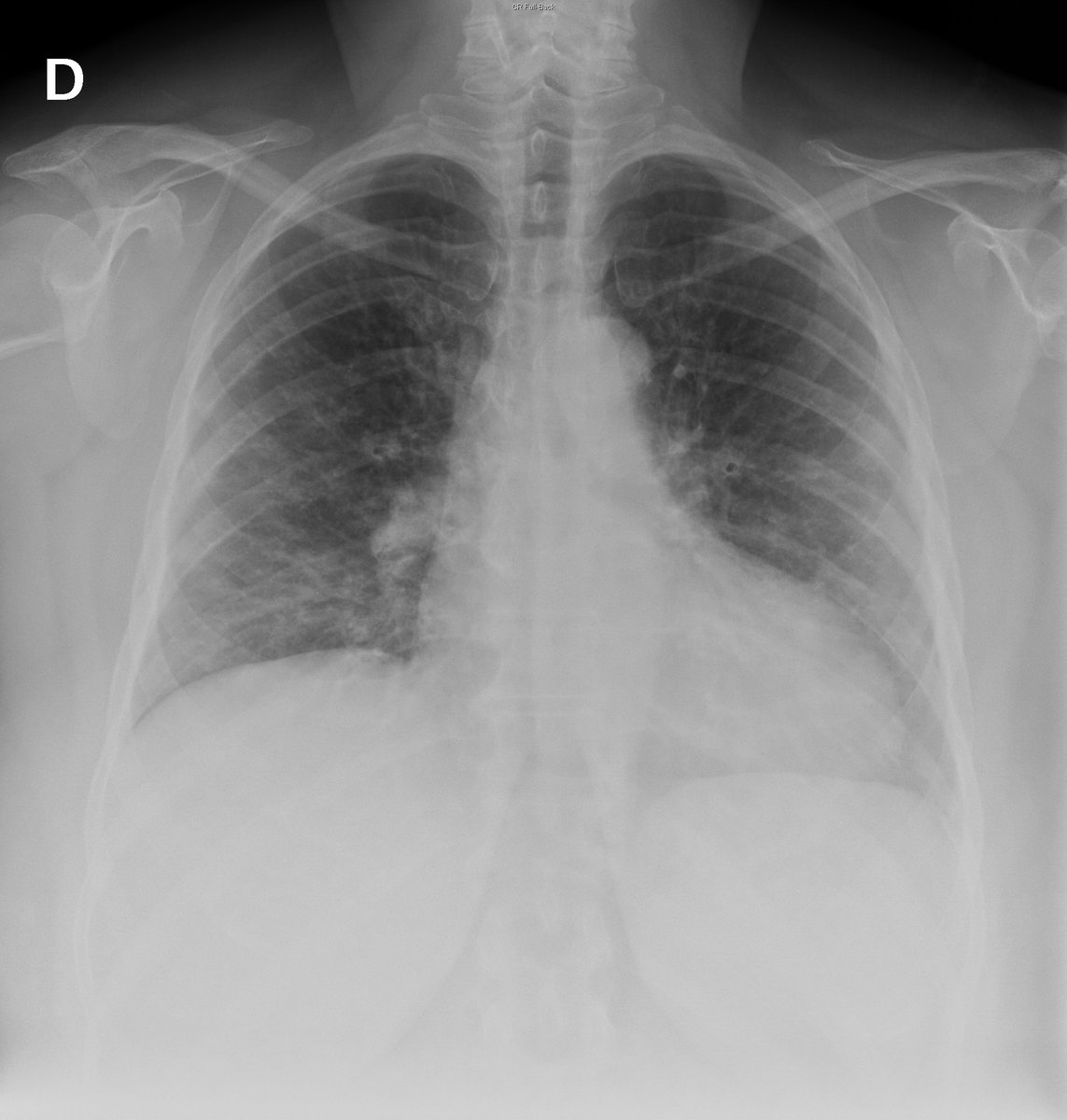 Case 20. 58yo female. Cough and dyspnea. Day 1 and 4.