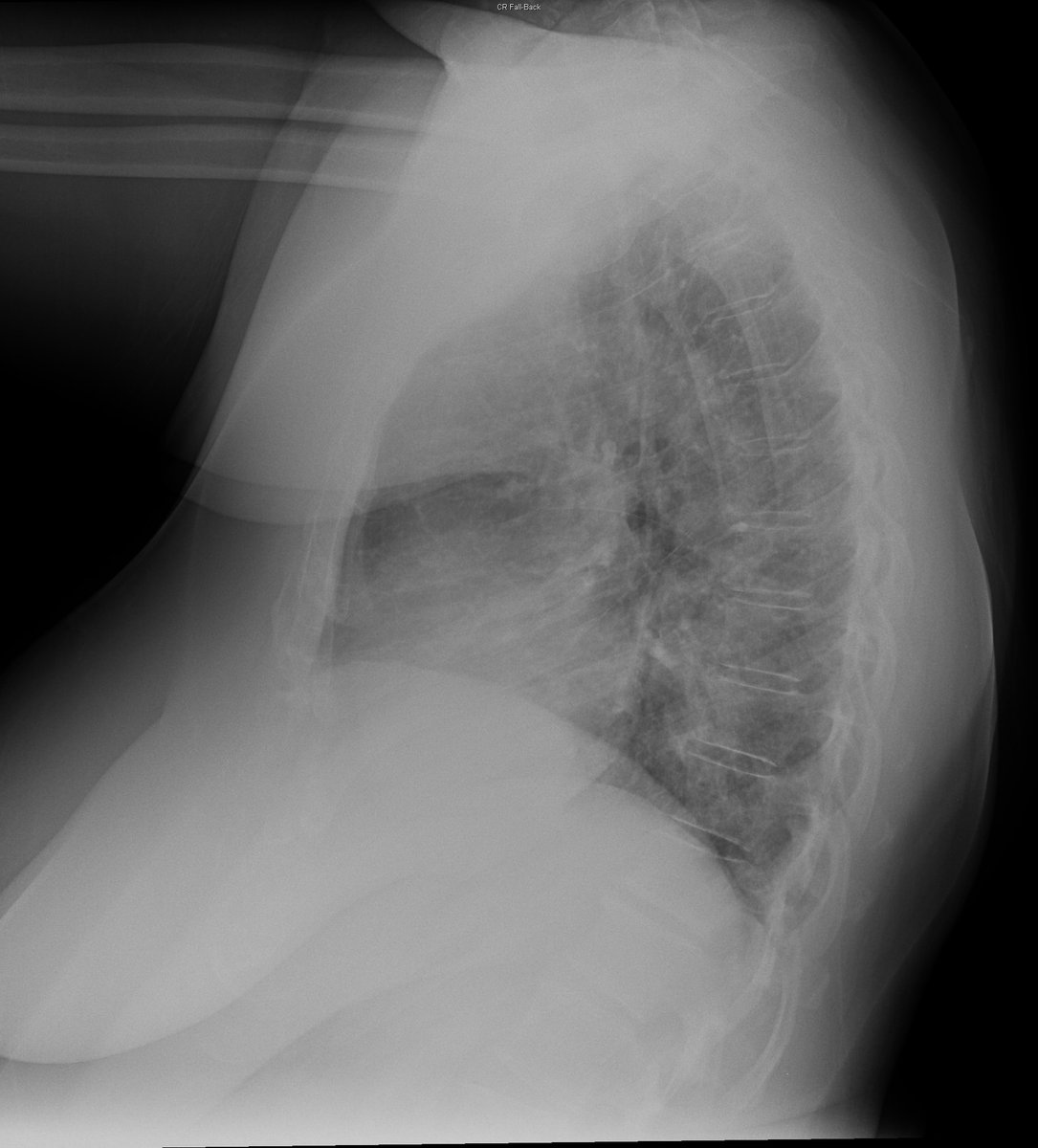 Case 20. 58yo female. Cough and dyspnea. Day 1 and 4.