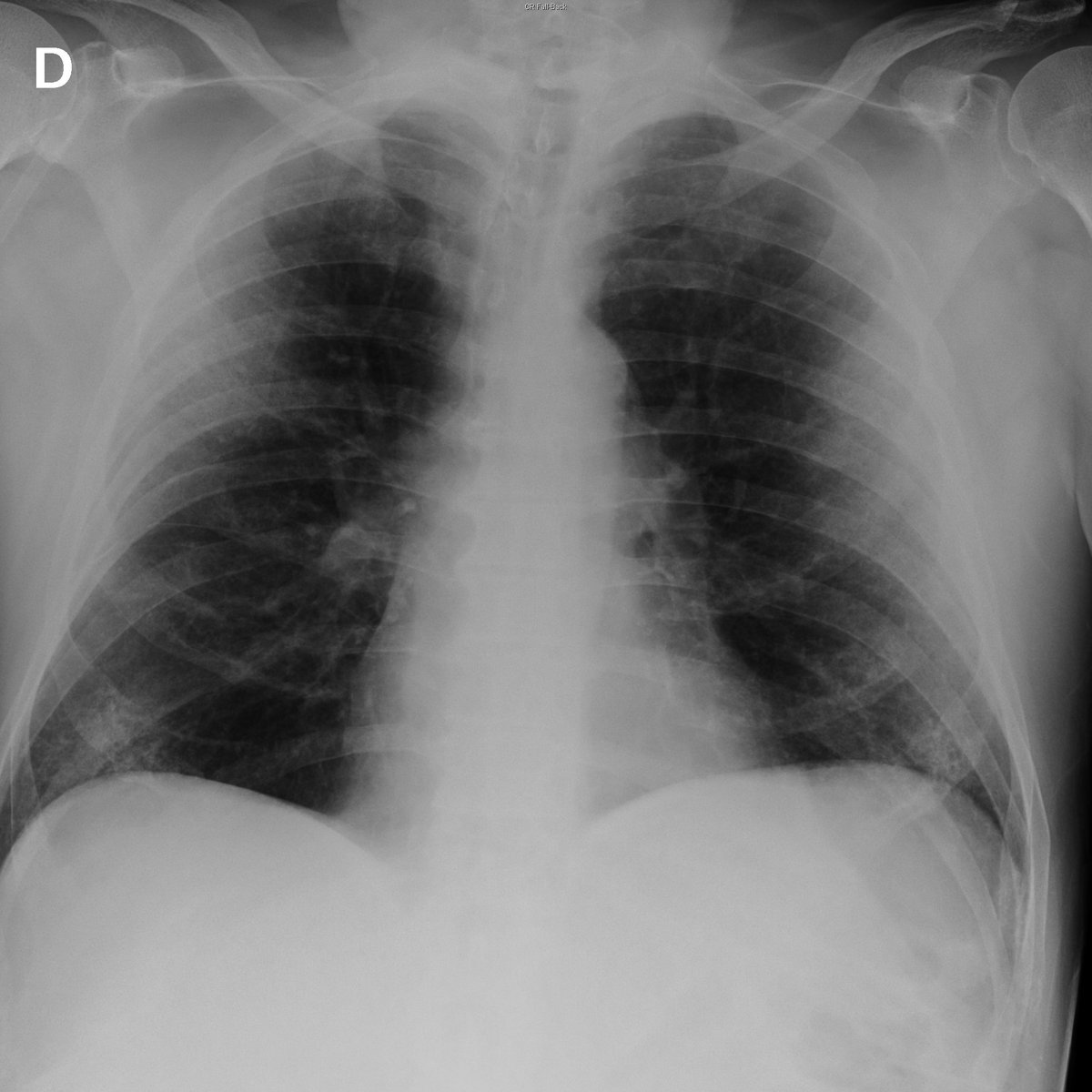 Case 21. 75yo male. Fever.