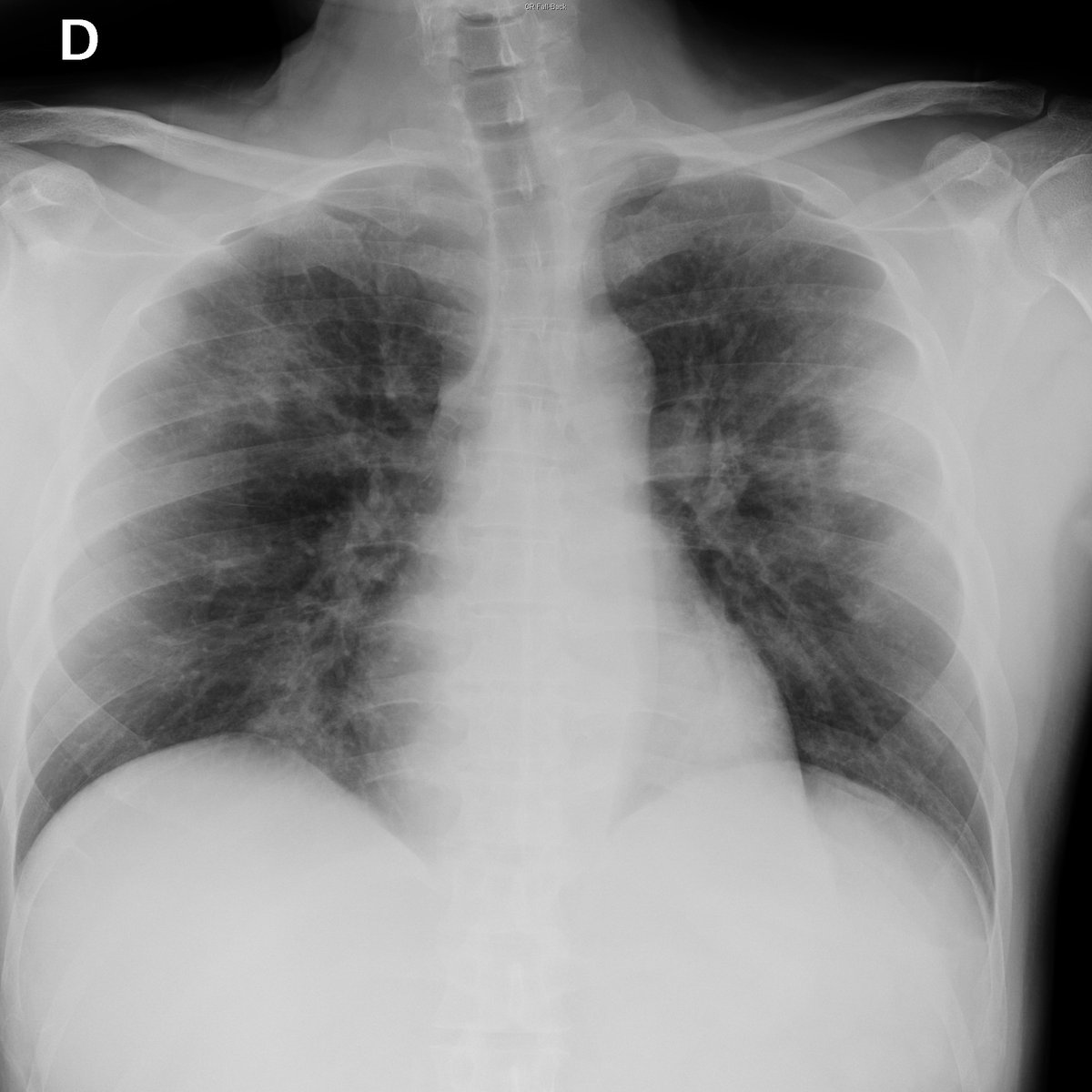 Case 22. 54yo male. Day 1 and 3.