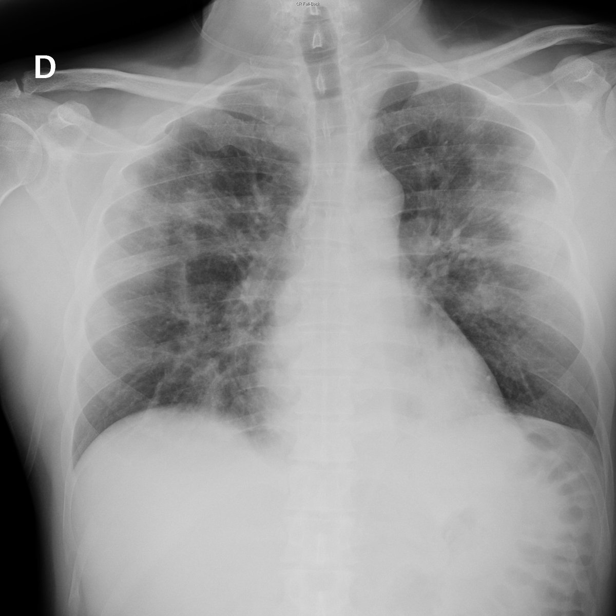 Case 22. 54yo male. Day 1 and 3.