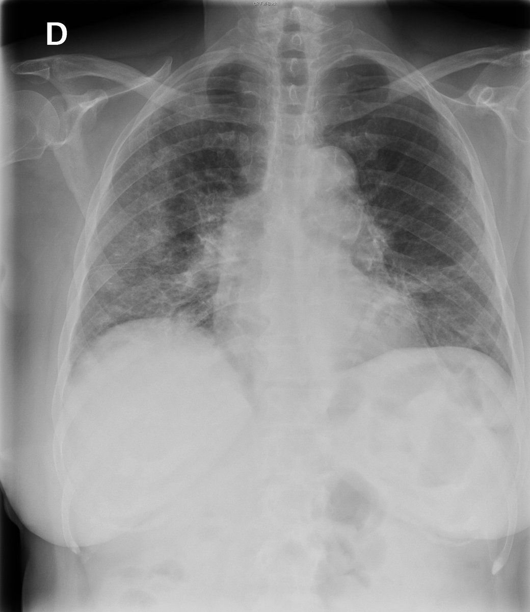 Case 27. 76yo female. Cough, dyspnea and fever. Day 1, day 1 (later same day), 3 and 6.