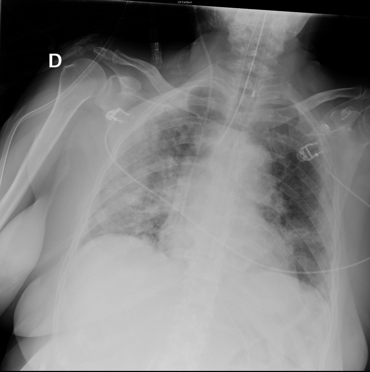 Case 27. 76yo female. Cough, dyspnea and fever. Day 1, day 1 (later same day), 3 and 6.